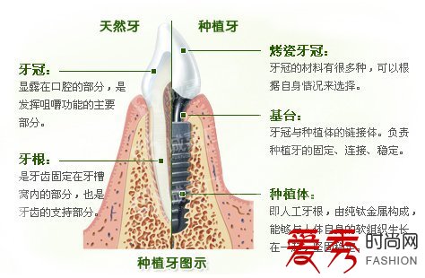 种植牙