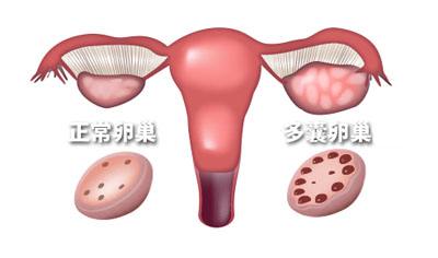 多囊卵巢综合症能治好吗 多囊卵巢能不能治好
