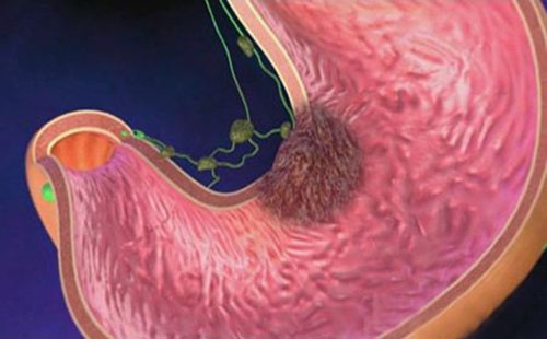 萎缩性胃炎是胃癌吗 萎缩性胃炎和胃癌的区别是什么